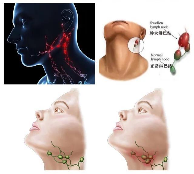 脖子淋巴结最新研究进展概览